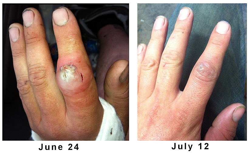 Read how one man quickly cured his MRSA staph infection naturally when doctors we're going to remove his finger and possibly his hand. (Graphic photos.)
