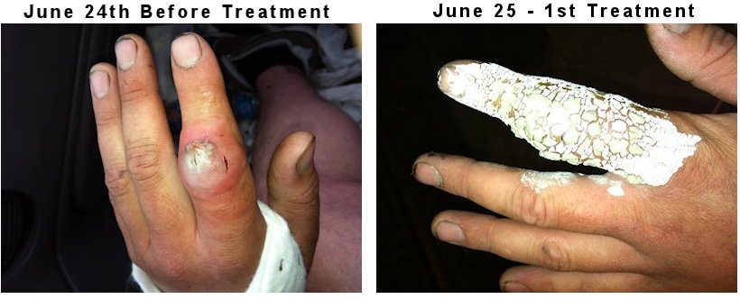 Read how one man cured his MRSA staph infection naturally when doctors we're going to remove his finger and possibly his hand. (Graphic photos.)