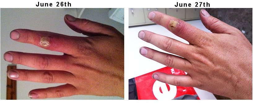 Read how one man cured his MRSA staph infection naturally when doctors we're going to remove his finger and possibly his hand. (Graphic photos.)